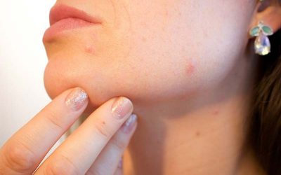 Severe Acne Treatment: What Are My Options?