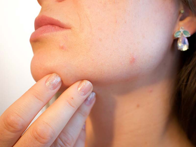 severe acne treatment